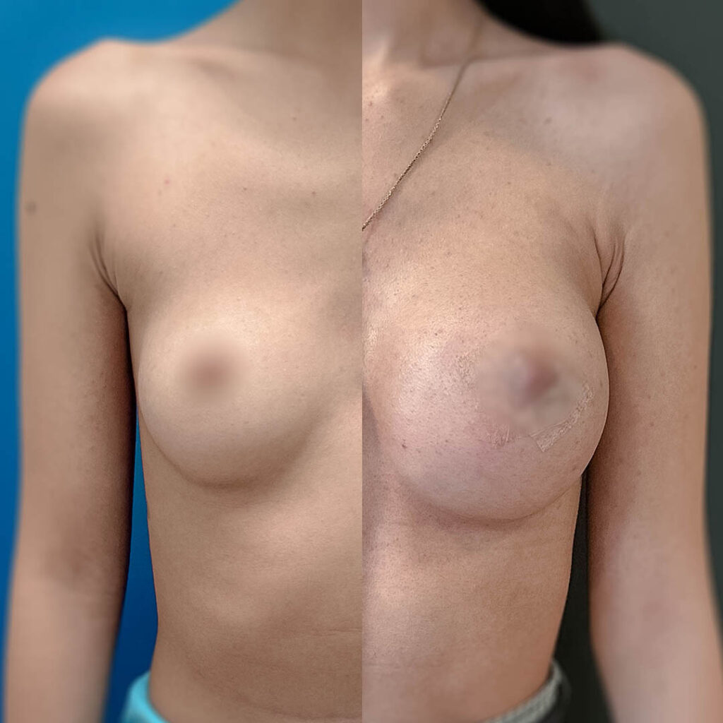 mamoplastia de aumento